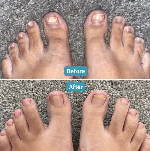 Lumy Laser Nail Fungus Device