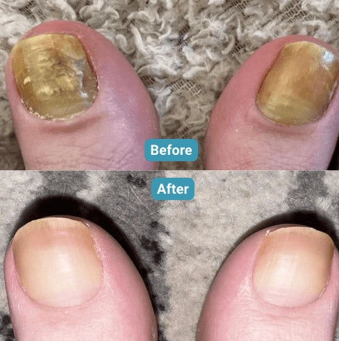 Lumy Laser Nail Fungus Device
